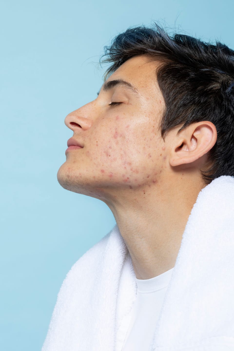 Como fazer a barba com espinhas e 4 produtos para usar
