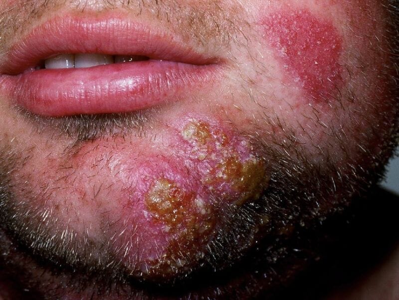 Micose na barba (Tinea barbae): entenda de uma vez por todas!