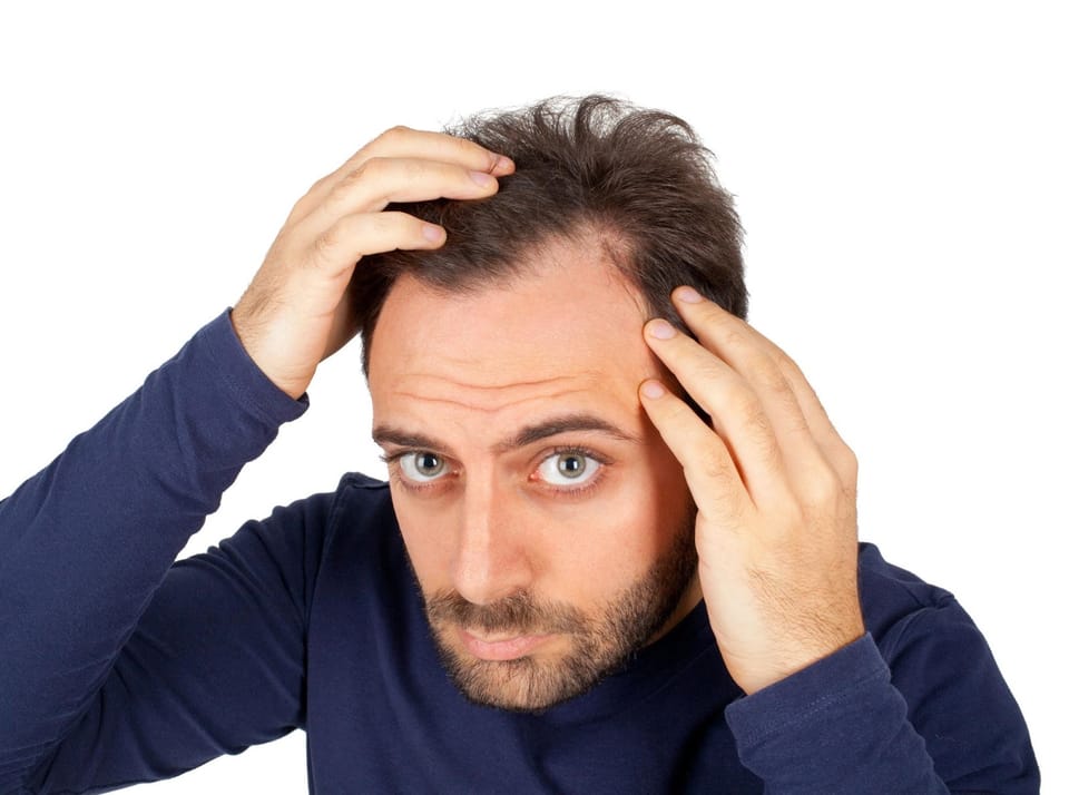 Tudo sobre calvície masculina (Alopecia androgenética)