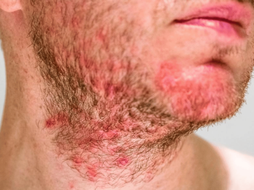 Homem Branco com Foliculite na Barba