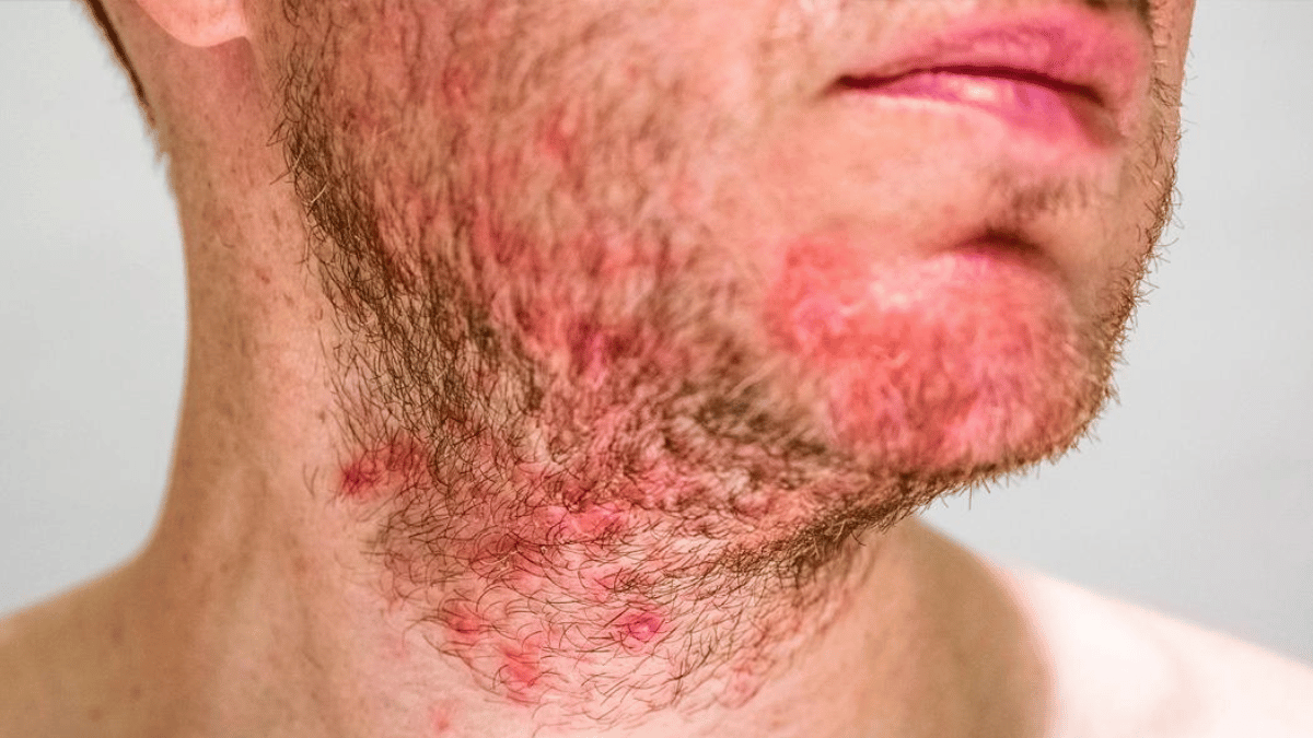 Homem Branco com Foliculite na Barba