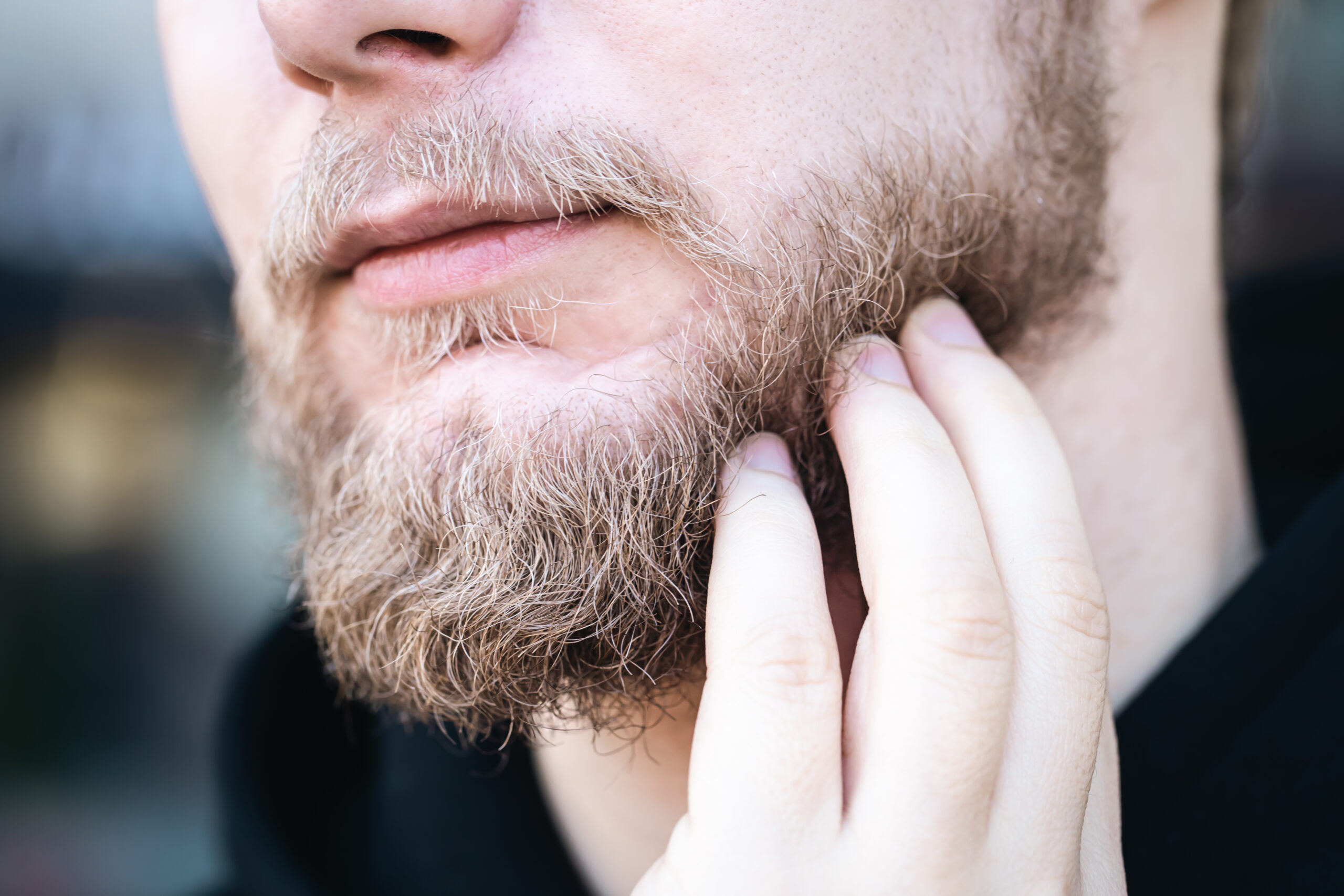 irritação na barba